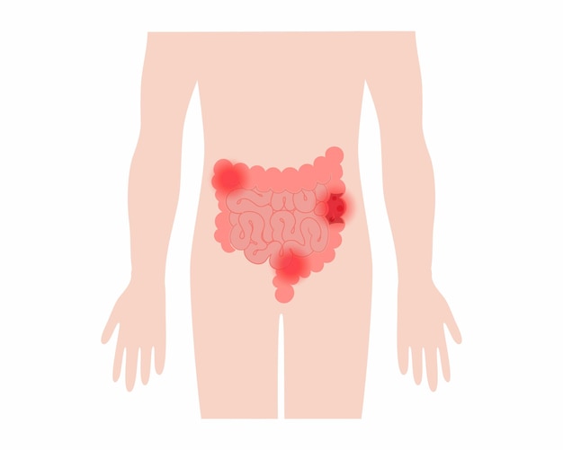 Inflammatory bowel disease abdominal pain in colon Human large intestines anatomy