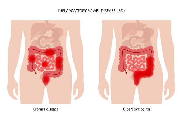 Malattia infiammatoria intestinale