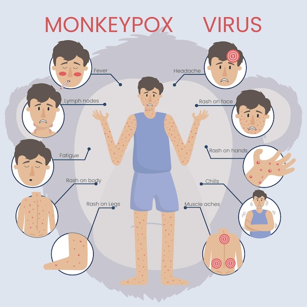 サル痘ウイルス2022年のインフォグラフィックの概念男性は天然痘とサル痘の症状に病気です