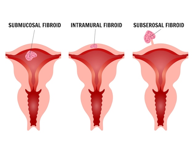 Infographic or female fibroids in vector illustration