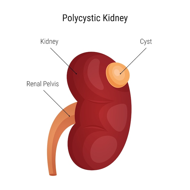 Infographic polycystic kidney disease