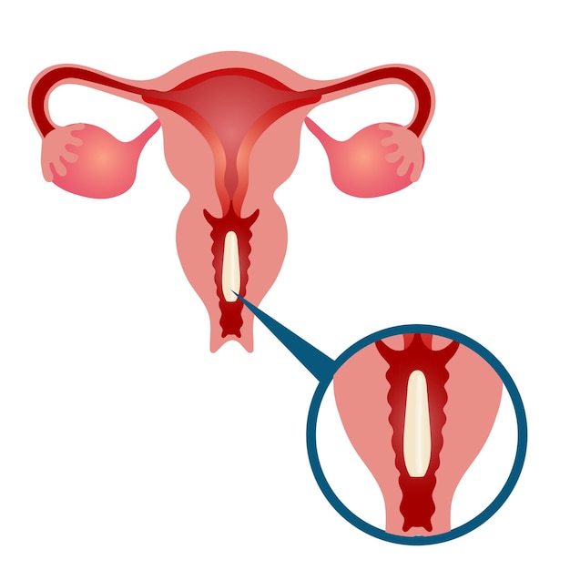 Infografica sul trattamento della vaginite nell'illustrazione vettoriale