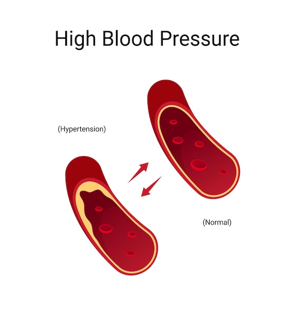 Infographics high blood pressure hypertension