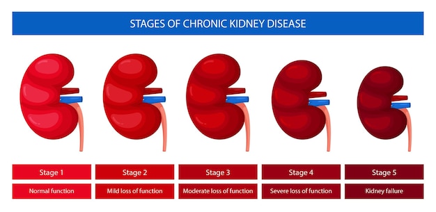 Vector infographics stages of chronic kidney disease