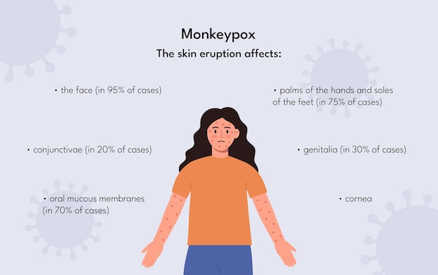 Information poster symptom of monkeypox