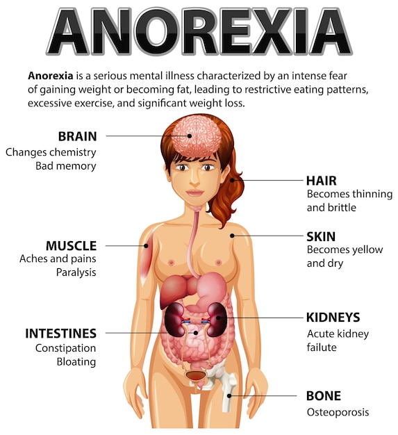 Vector informative poster of anorexia eating disorder