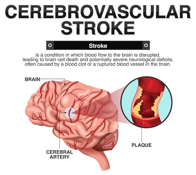 Информационный плакат Цереброваскулярный инсульт