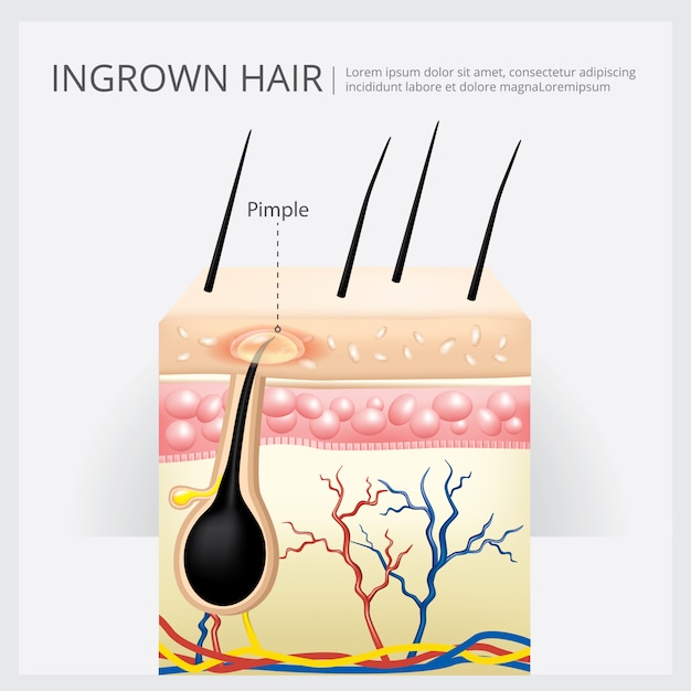 Ingegroeide haarstructuur