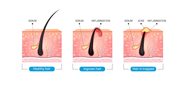 Vettore peli incarniti dopo la rasatura, i peli sono ricresciuti sulla superficie della pelle. formazione di acne sulla pelle