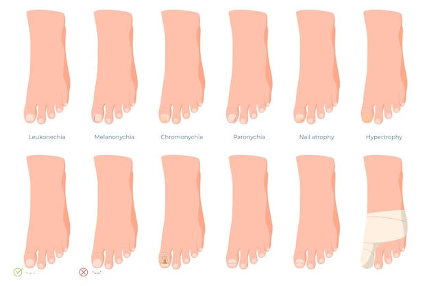 ingrown toenails diseases of the toes treatment and care of problem nails vector illustration
