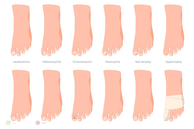 Vector ingrown toenails diseases of the toes treatment and care of problem nails vector illustration