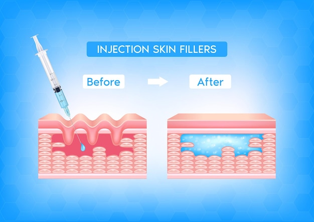 벡터 주름진피층이 있는 얼굴 피부 아래에 주사 필러 주입 전후
