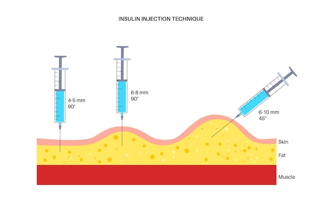 Вектор Техника инъекций инсулина болезнь диабета различные инъекции для взрослых и детей шприц входит в жировой слой через кожу и не касается мышц анатомическая плоская векторная иллюстрация