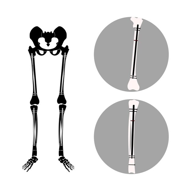 Vector internal nail in an adult femur