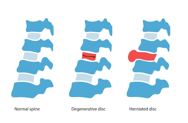 Intervertebral hernia