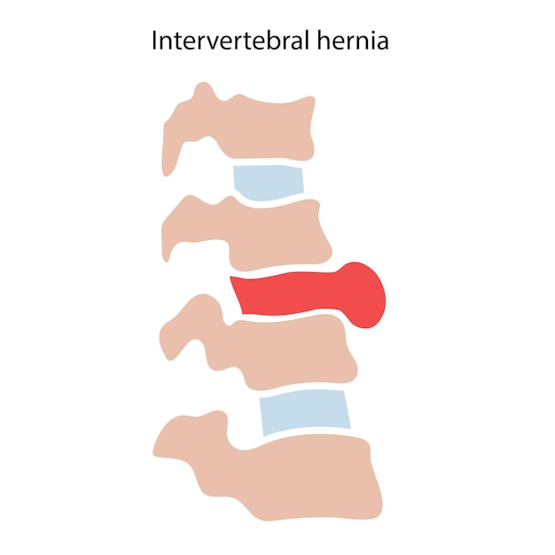 Vector intervertebral hernia