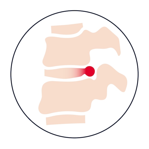 Vector intervertebral hernia