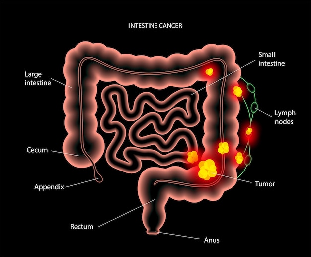 Cancro 3d dell'intestino