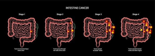 Intestine 3D cancer