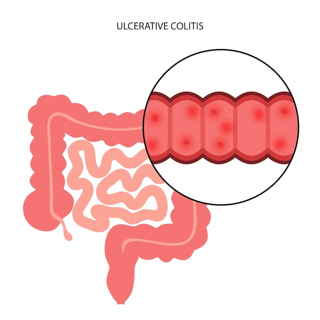 Vector intestine ulcerative colitis