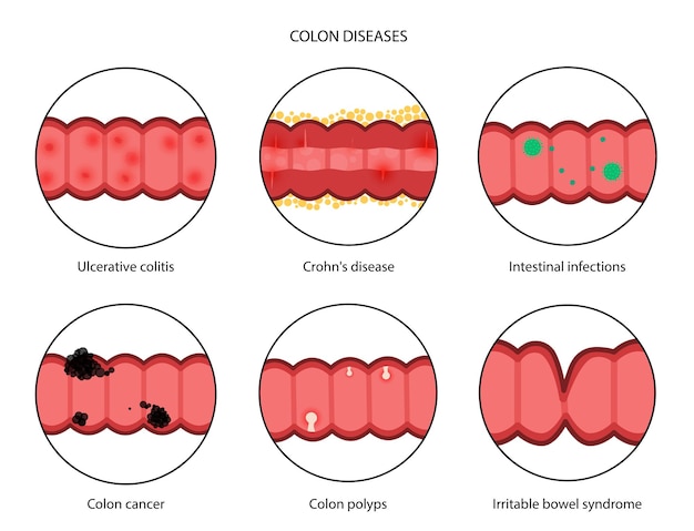 Vector intestines diseases concept