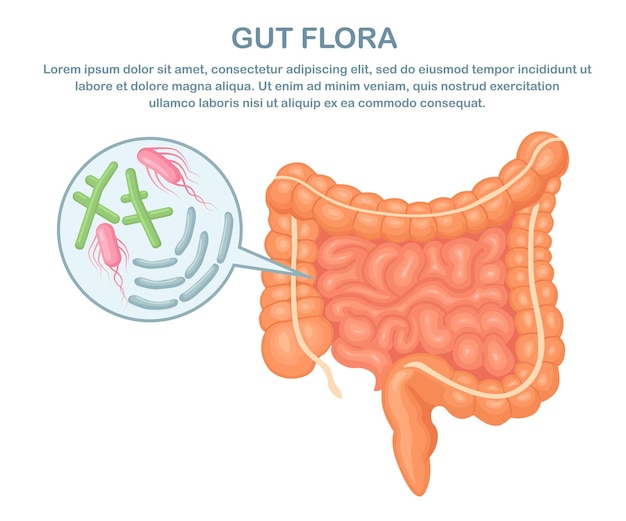 Sobrecrecimiento bacteriano intestinal