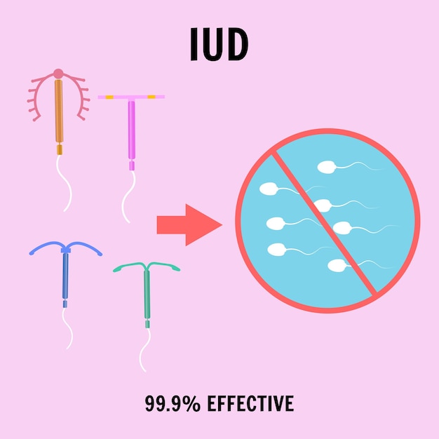 Intrauterine device contraception in vector