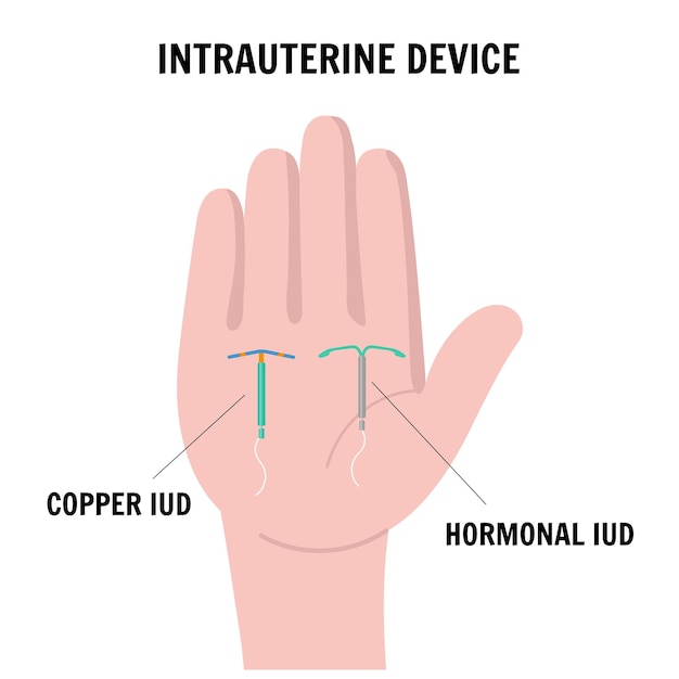 Внутриматочная спираль медь и гормональная ВМС на руке в векторе