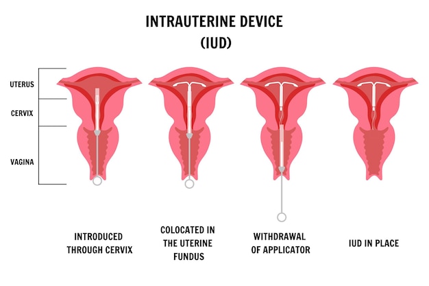 Vector intrauterine device iud infographic in vector