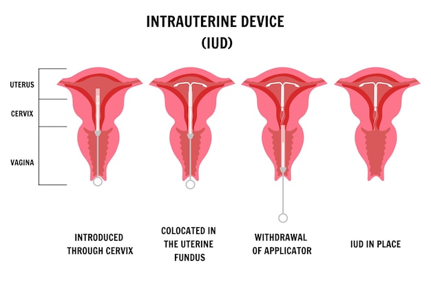Инфографика внутриматочного устройства в векторе