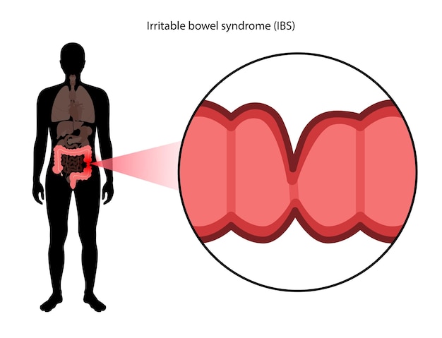 Vettore sindrome dell'intestino irritabile