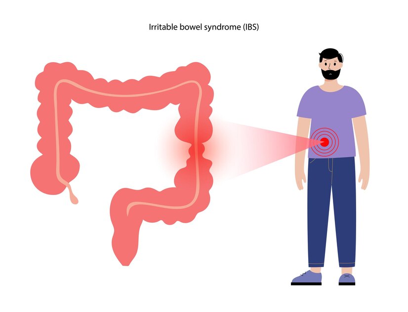 Que tomar para el colon irritable