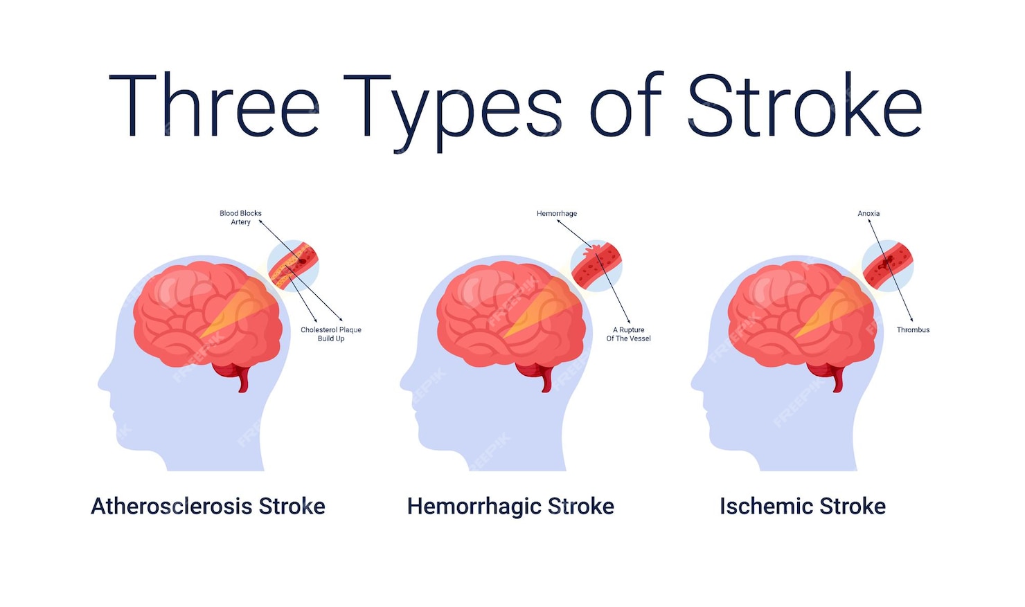 atypical presentation of ischemic stroke