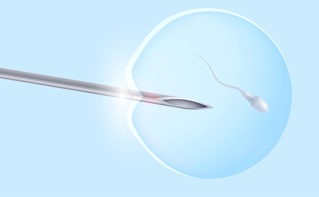 정자가 있는 난자의 Ivf 시험관 수정 의료용 바늘이 정자를 난자에 이식합니다. 의료 포스터 벡터 일러스트 레이 션