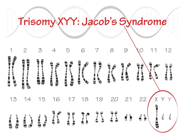 Cariotipo della sindrome di jacobs