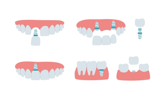 Jaw with healthy teeth and dental implant, dental bridge