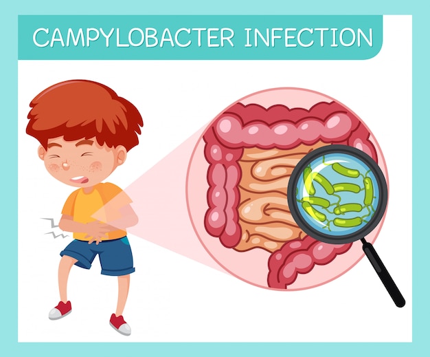 Jongen met campylobacter-infectie