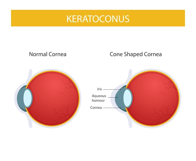 Vector keratoconus disease, infographic design illustration of keratoconus