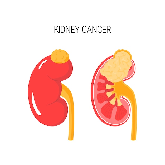 Kidney cancer concept in flat style