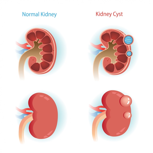 Kidney cyst step diagram.