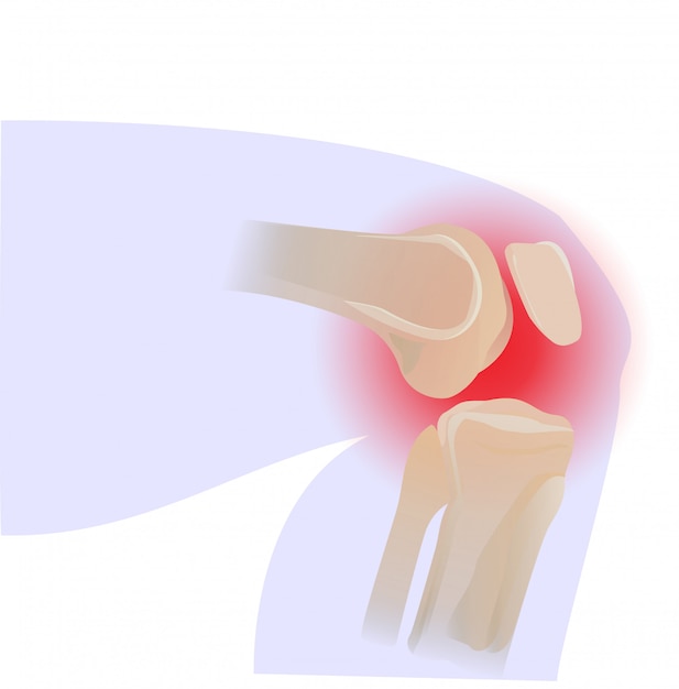 ベクトル 膝の痛み