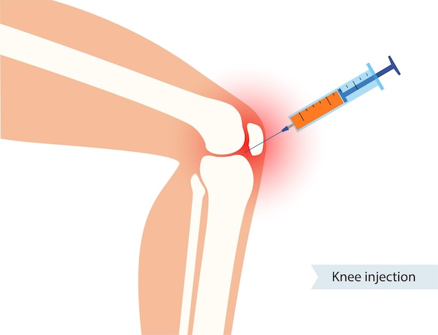 Vector knie-injectie