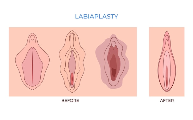 Labiaplasty vaginoplasty women genital of minor Vulval labia loose lips beauty surgery to tighten