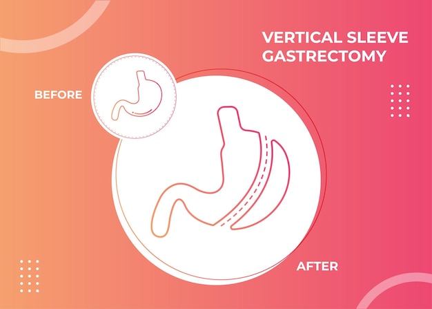 Laparoscopic sleeve gastrectomy, vertical gastrectomy, weight loss surgery vector illustration of st