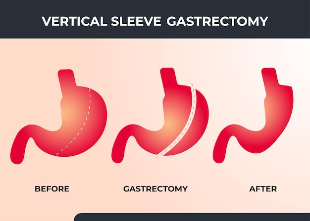 Laparoscopic sleeve gastrectomy vertical gastrectomy weight loss surgery vector illustration