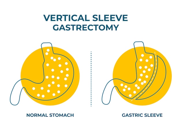 Laparoscopic sleeve gastrectomy vertical gastrectomy weight loss surgery vector illustration