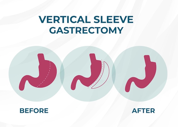 Laparoscopic Sleeve Gastrectomy Vertical Gastrectomy Weight loss surgery Vector Illustration