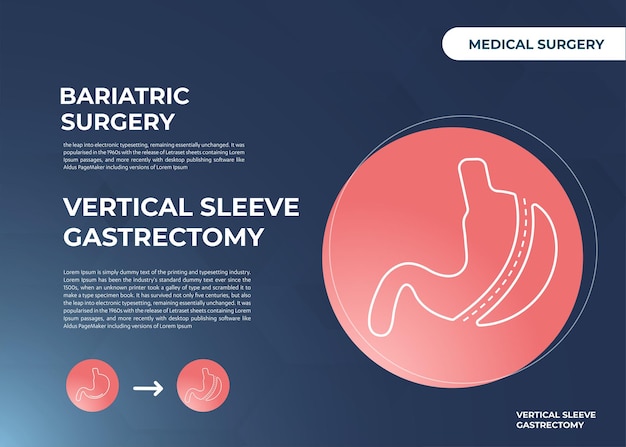 Laparoscopische mouw gastrectomie, verticale gastrectomie, gewichtsverlies chirurgie vectorillustratie van st