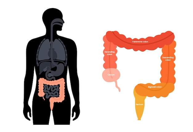 대장 해부학적 포스터 인간 장의 섹션 소화기 검사 및 위장병 진료소의 치료 격리된 벡터 일러스트레이션을 위한 결장의 인포그래픽