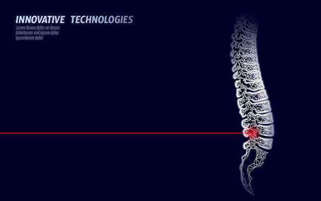 Laserfysiotherapie menselijk ruggenmergletsel. pijngebied operatie operatie moderne lendenen geneeskunde technologie laag poly driehoeken 3d render vrouwelijke rug hernia illustratie